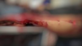 Korban penganiayaan, Lukman. (Foto: LOMBOKINI.com).